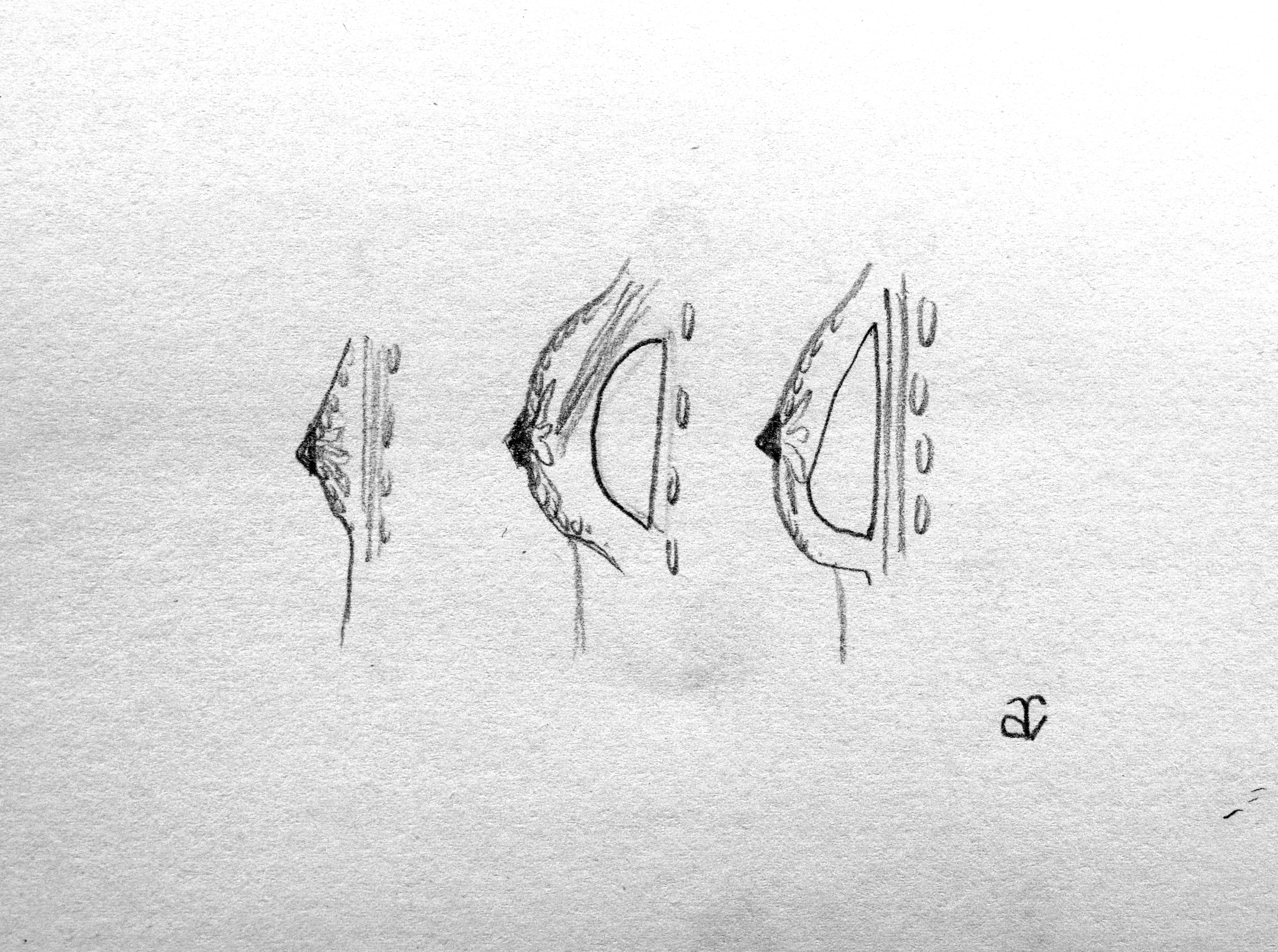 plano del implante mamario